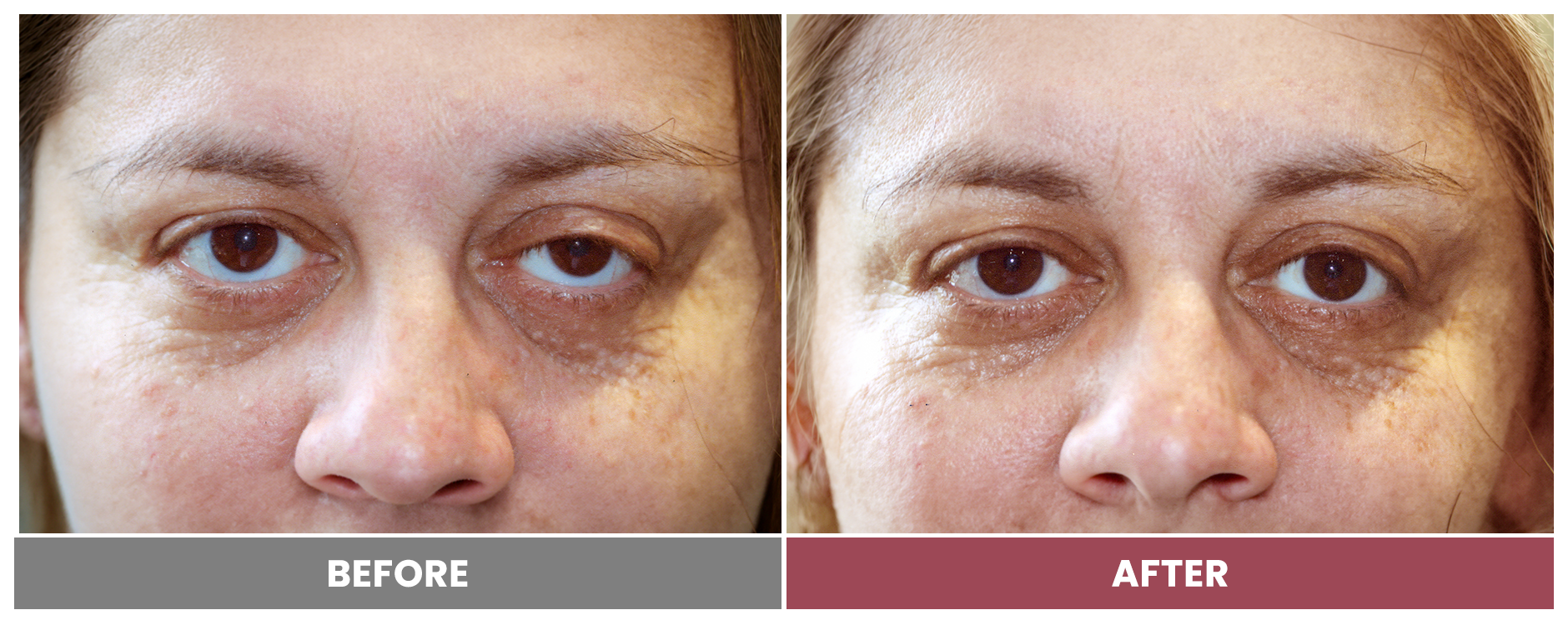 PTOSIS REPAIR - Case 14